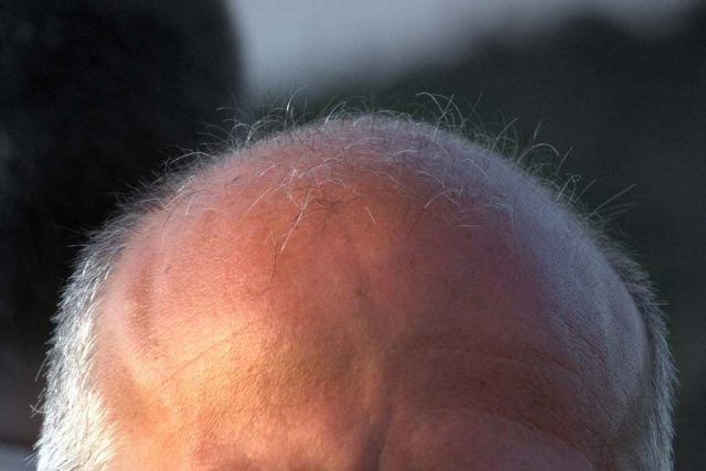 Foto av tunnhårigt manshuvud.
